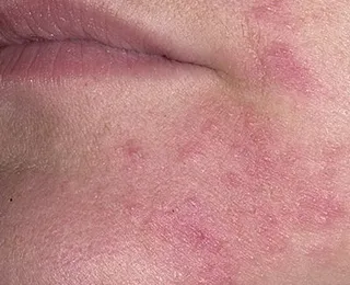 manifestări alergice cutanate (pete) si tipuri (dermatita atopica eczema) manifestări alergice cutanate (pete) și tipuri