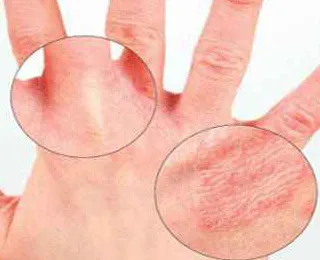 manifestări alergice cutanate (pete) si tipuri (dermatita atopica eczema) manifestări alergice cutanate (pete) și tipuri