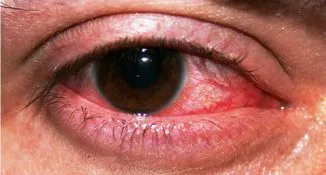 Alergia mancarimi ale ochilor si apoase, umflate - edem decât pentru tratarea pleoapelor de copii și adulți