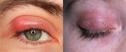 Alergia ochiului pleoapelor cauze, simptome, tratament (tratament) Alergia din cauze pleoapelor ochi, simptome, tratament