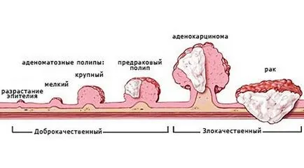 polip adenomatos simptome endometriale și tratament, dacă este nevoie de o intervenție chirurgicală