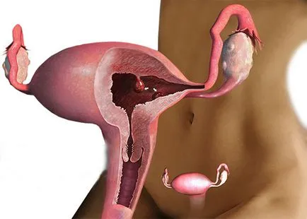 polip adenomatos simptome endometriale și tratament, dacă este nevoie de o intervenție chirurgicală
