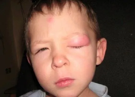 Alergic la intepaturi de tantar un copil și un adult, cum să se ocupe cu edem (copil) Alergic la intepaturi de tantar un copil și un adult, cum să se ocupe cu umflarea