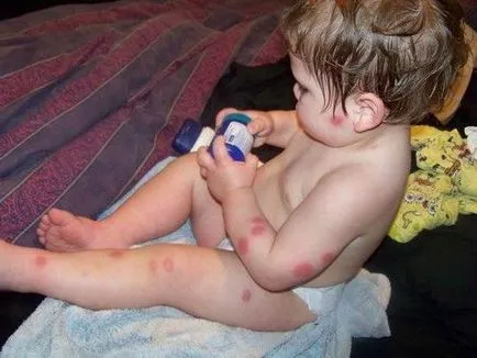 Alergic la intepaturi de tantar un copil (alergie) Alergic la intepaturi de tantar un copil