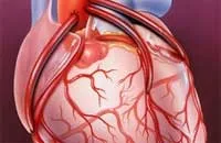 chirurgie de by-pass aorto-coronarian sau presedinti - infarct (la suta din cazuri în interior) chirurgie sau președinți de by-pass aorto-coronarian - infarct