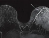mamografii gratuite