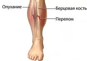 Tibia în cazul în care tratamentul fracturilor de ei, tipurile lor (de tratament) Tibia în cazul în care tratamentul fracturilor de ei, tipurile lor