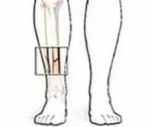Tibia în cazul în care tratamentul fracturilor de ei, tipurile lor (oase) Tibia în cazul în care tratamentul fracturilor de ei, tipurile lor