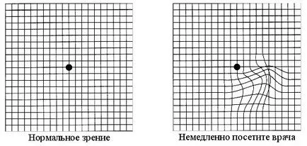 examene ochi on-line de masă Sivtseva, vulturi, Amsler (on-line) examene oftalmologice gratuite de masă Sivtseva on-line, vulturi, Amsler