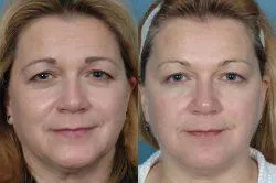 Biorevitalizare cât de des, cât de des să
