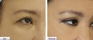 Blefaroplastia de pregătire pleoapelor superioare pentru chirurgie, perioada de reabilitare (reabilitare) Blefaroplastia de pregătire pleoapelor superioare pentru o intervenție chirurgicală, perioada de reabilitare