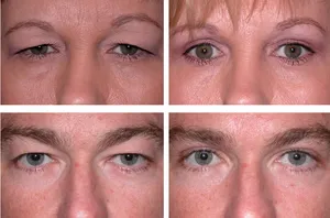 Blefaroplastia de pregătire pleoapelor superioare pentru chirurgie, perioada de reabilitare (perioada) Blefaroplastia de pregătire pleoapelor superioare pentru o intervenție chirurgicală, perioada de reabilitare