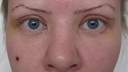 pleoapa superioară procedura de blefaroplastie, prețurile, înainte și după fotografii, video