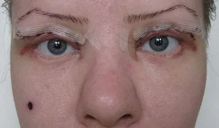 pleoapa superioară procedura de blefaroplastie, prețurile, înainte și după fotografii, video