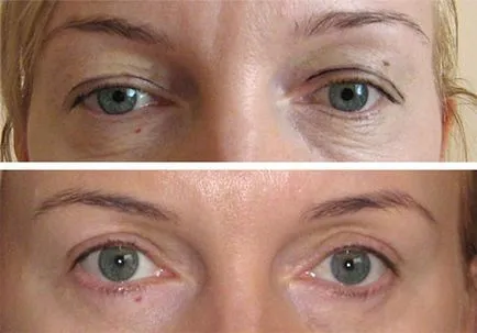 pleoapa superioară procedura de blefaroplastie, prețurile, înainte și după fotografii, video