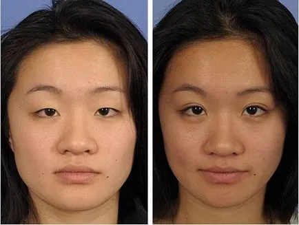 pleoapa superioară procedura de blefaroplastie, prețurile, înainte și după fotografii, video
