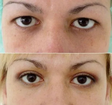 pleoapa superioară procedura de blefaroplastie, prețurile, înainte și după fotografii, video