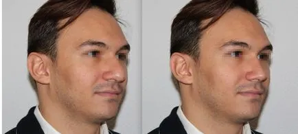 Big nas - simptome; Cum de a reduce nasul lung și lat (scădere) Big nas - simptome; Cum de a reduce nasul lung și lat