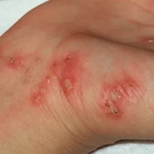 simptome scabie, fotografie, semne timpurii la adulți, metode de tratament