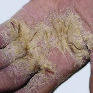 simptome scabie, fotografie, semne timpurii la adulți, metode de tratament