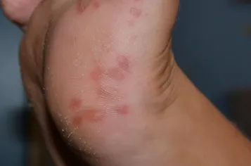 corp Râios, și de a afla cauza de vezicule și de tratament, cresteri ale pielii (Lechi) corp Râios, și de a afla cauza de vezicule și de tratament, excrescente pe piele