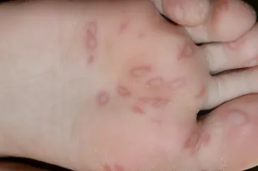 corp Râios, și de a afla cauza blistere si-tratament, cresteri ale pielii (apar) corp Râios, și de a afla cauza de vezicule și de tratament, excrescente pe piele