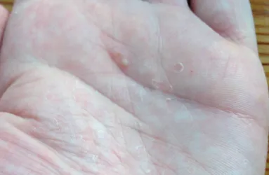 corp Râios, și de a afla cauza blistere si-tratament, cresteri ale pielii (apar) corp Râios, și de a afla cauza de vezicule și de tratament, excrescente pe piele