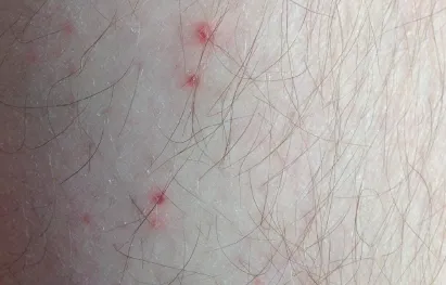 corp Râios, și de a afla cauza blistere si-tratament, excrescente pe piele (vezicule) corp Râios, și de a afla cauza de vezicule și de tratament, excrescente pe piele