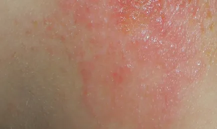 corp Râios, și de a afla cauza blistere si-tratament, excrescente pe piele (vezicule) corp Râios, și de a afla cauza de vezicule și de tratament, excrescente pe piele