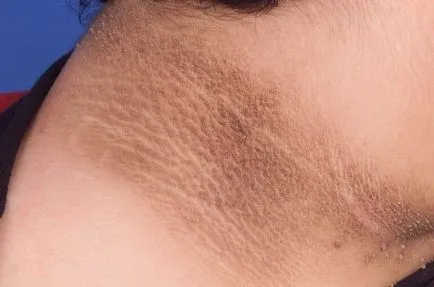 Acanthosis nigricans la om cauze, tratamente, foto (cauza) Acanthosis nigricans la om cauze, tratament, fotografii