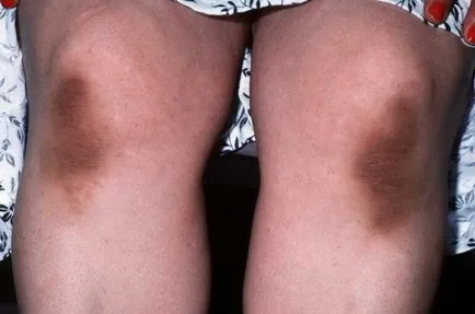 Acanthosis nigricans la om cauze, tratamente, foto (Human) Acanthosis nigricans la om cauze, tratament, fotografii