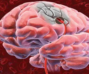 Ce este un accident vascular cerebral