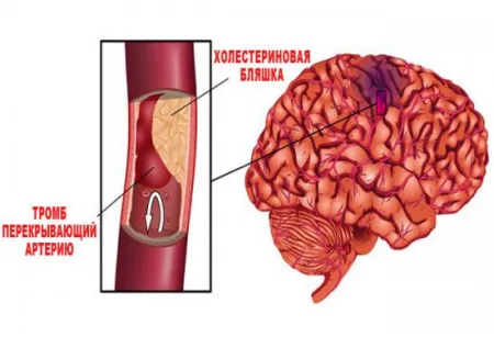 Care sunt primele semne ale unui accident vascular cerebral și consecințele posibile ale (a) Care sunt primele semne ale unui atac cerebral și consecințele posibile
