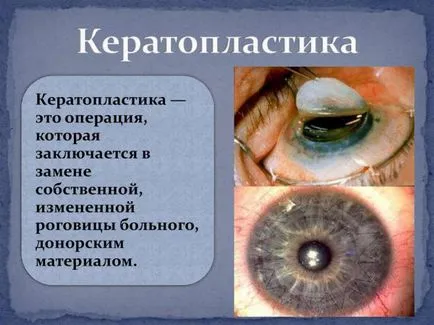 tratamentul corneei ochi distrofie și că este, epitelială, endoterialnaya, remedii populare