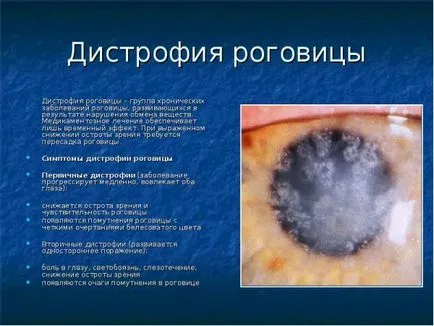 tratamentul corneei ochi distrofie și că este, epitelială, endoterialnaya, remedii populare