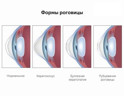 tratamentul corneei ochi distrofie și că este, epitelială, endoterialnaya, remedii populare