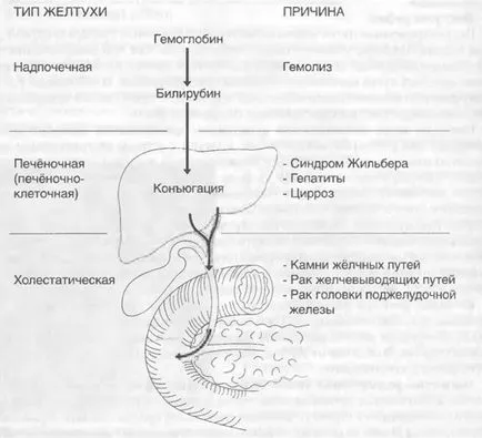 Diagnosticul diferențial de icter