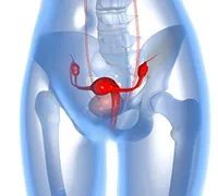 Bicamerală lasat chist ovarian (chist) Bicamerală lasat chist ovarian