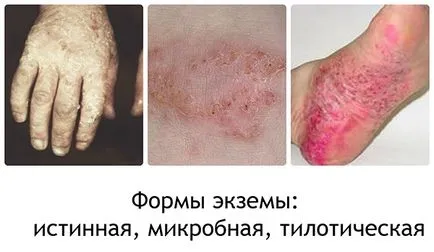Eczeme pe picioare cauze, simptome, imagini, metode de tratament și remedii populare