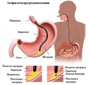 Upper endoscopie, ei CST