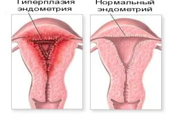 Proliferative endometru tip pas