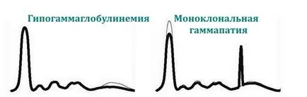 Electroforeza proteinelor sanguine