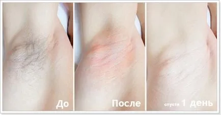 reguli Epilator și sfaturi