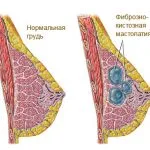 Fibro chistica Tratamentul simptomelor bolii de san de remedii populare