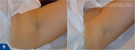 Fotoepilație - comentarii, contraindicații și efecte, prețuri