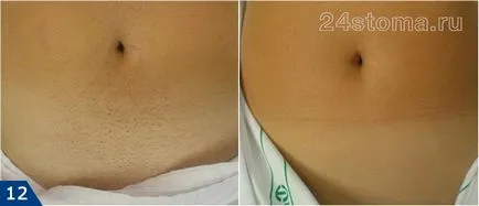 Fotoepilație - comentarii, contraindicații și efecte, prețuri
