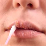 Herpes cauze, simptome, tratament