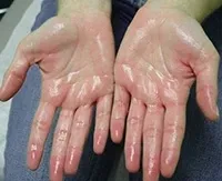 Hiperhidroza palmele și picioarele ce este, cauze, simptome, tratamente pentru transpirația mâinilor și picioarelor (picioare) Hiperhidroza palmele și picioarele ce este, cauze, simptome, tratamente pentru transpirația mâinilor și picioarelor