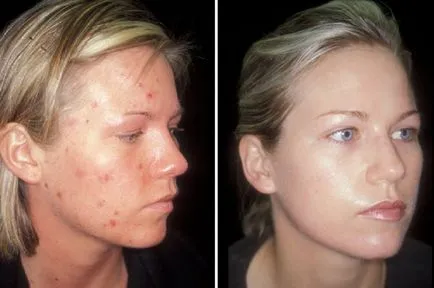Albastru argilă utilizare facială