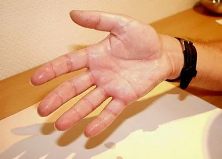Hiperhidroză palmelor cauze, simptome, tratament (hiperhidroză) Hiperhidroză palmelor cauze, simptome, tratament